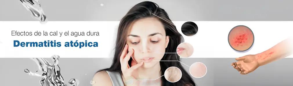 Dermatitis atópica en piel, agua dura y cal