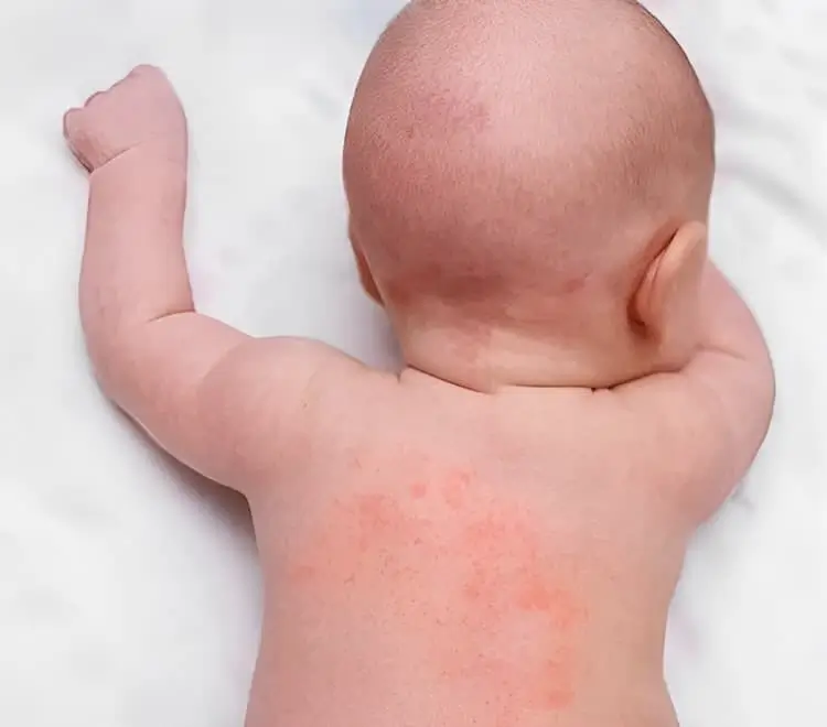 Dermatitis atópica en la piel bebé