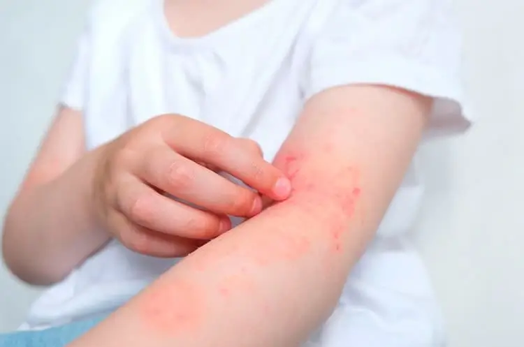Dermatitis atópica
